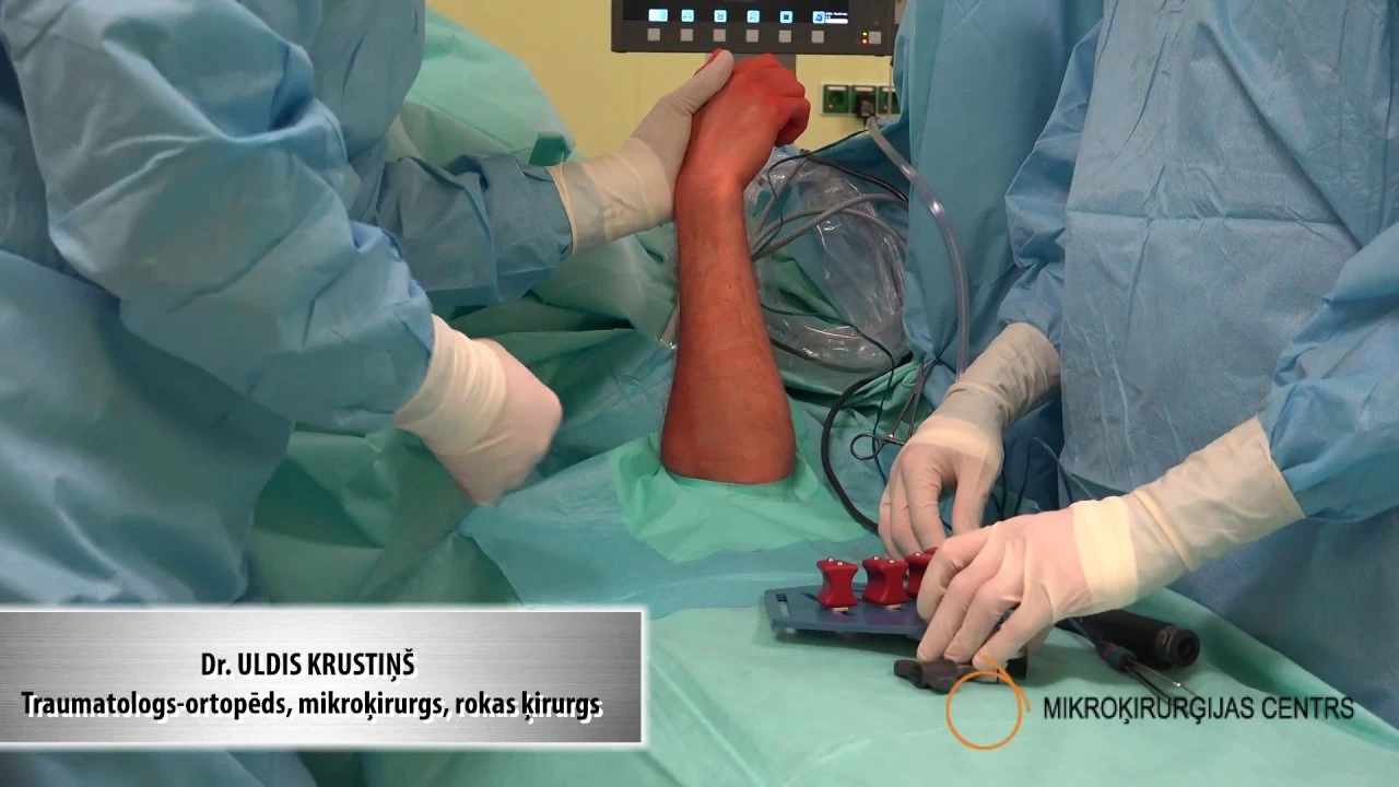Plaukstas locītavas artroskopija vai triangulārā fibro skrimšļa operācija